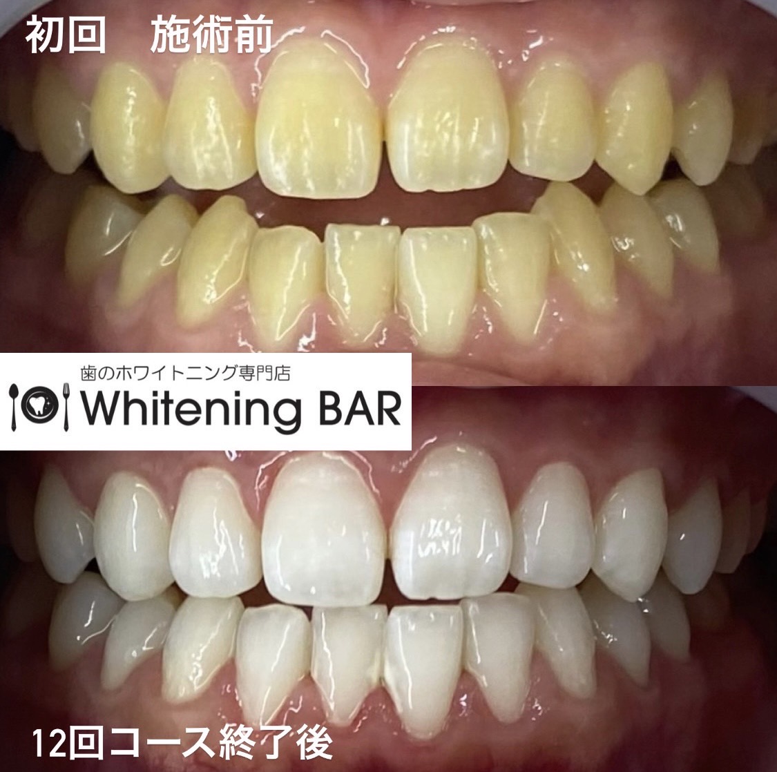 WhiteningBARセルフホワイトニング12回コースのビフォーアフター事例