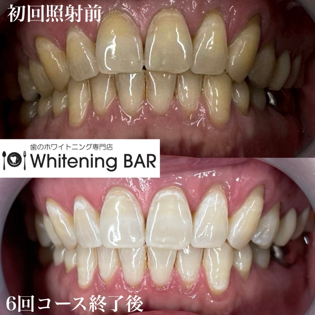 WhiteningBARセルフホワイトニング6回コースのビフォーアフター事例