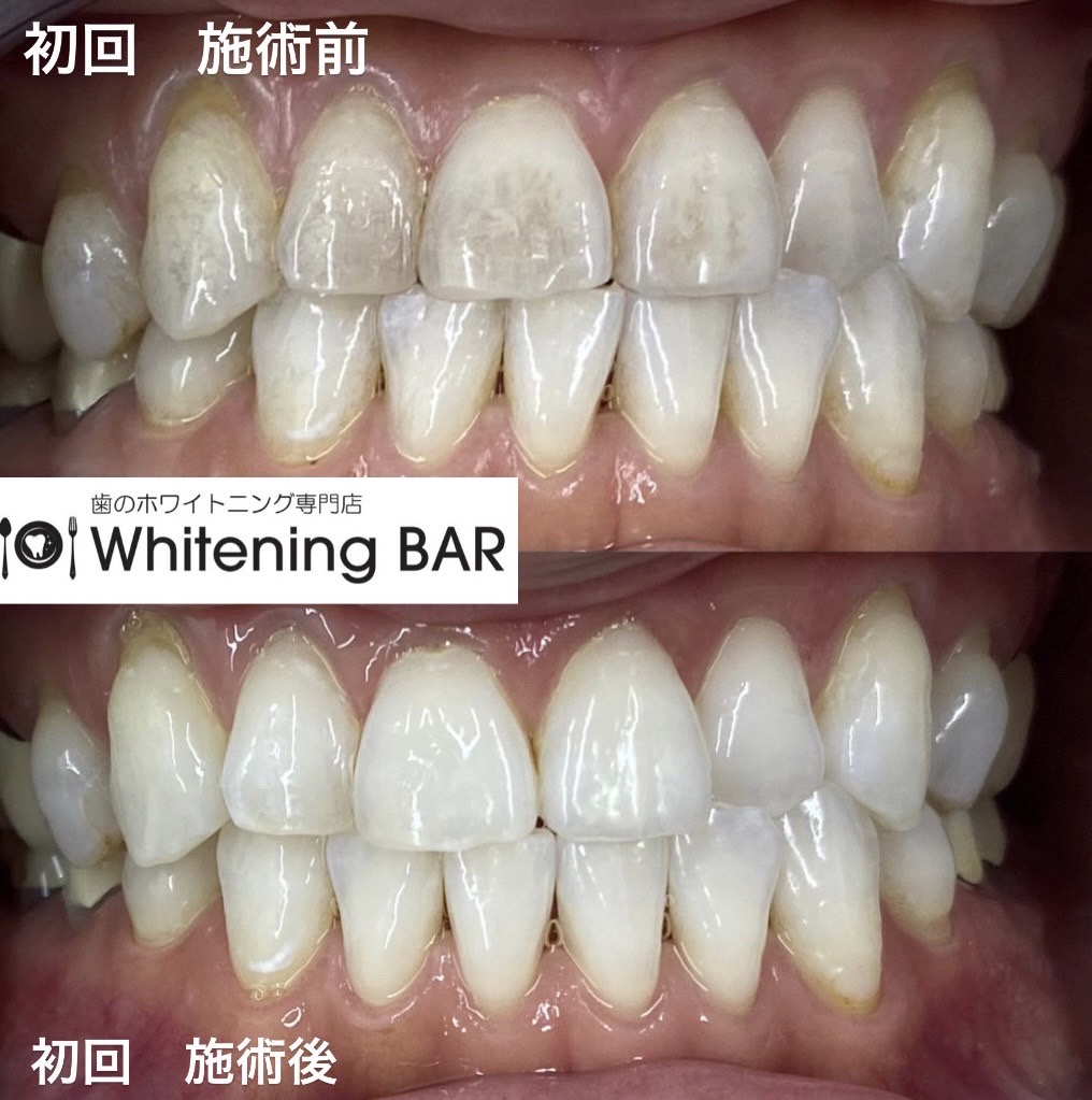 WhiteningBARセルフホワイトニング初回施術のビフォーアフター事例