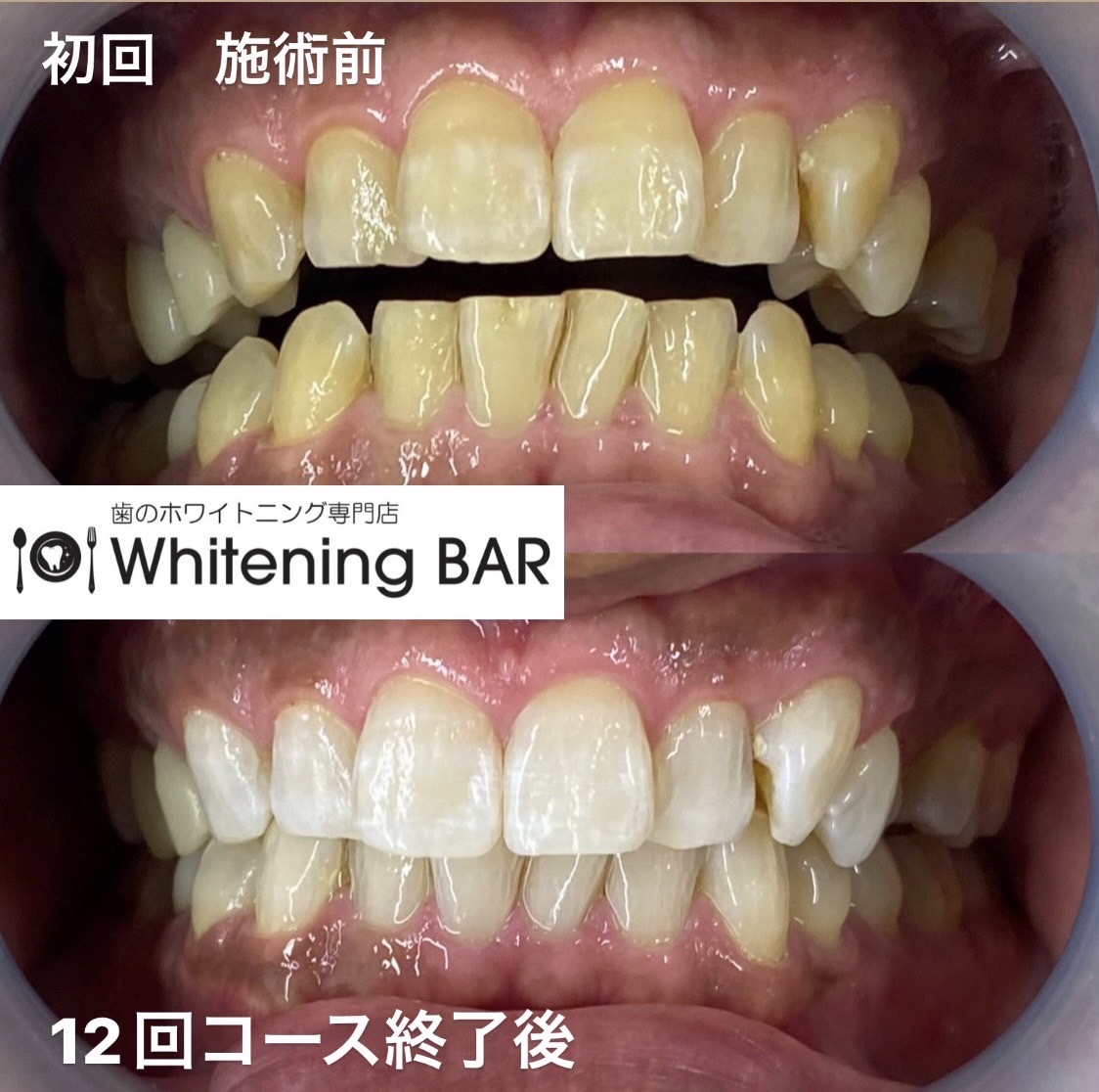WhiteningBARセルフホワイトニング12回コースのビフォーアフター事例